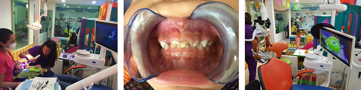 Odontología láser para niños