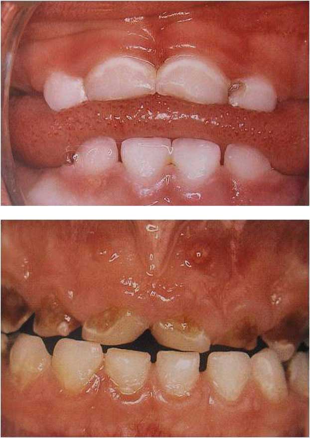 Caries del biberón en bebés